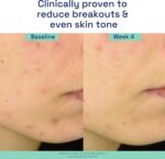 ⁦سيتافيل مصل علاج حب الشباب ثلاثي المفعول مع حمض الساليسيليك، يعالج ويمنع حب الشباب، رائع لعلامات ما بعد حب الشباب، لجميع انواع البشرة، 1 اونصة⁩ - الصورة ⁦7⁩