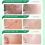 ⁦جل علاج حب الشباب من تي تري 3 قطع، علاج البقع المضادة لحب الشباب للوجه بتركيبة مرطبة، يتلاشى البثور والبقع الداكنة، يتحكم في الزيت وينكمش المسام للحصول على بشرة نقية وناعمة⁩ - الصورة ⁦5⁩