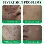 ⁦جل علاج حب الشباب من تي تري 3 قطع، علاج البقع المضادة لحب الشباب للوجه بتركيبة مرطبة، يتلاشى البثور والبقع الداكنة، يتحكم في الزيت وينكمش المسام للحصول على بشرة نقية وناعمة⁩ - الصورة ⁦2⁩