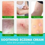 ⁦كريم مضاد للفطريات، كريم مضاد للحكة بمكونات عشبية اكثر لطفًا وامانًا، يعيد الحكة بسرعة للوجه والجسم ويساعد على اكزيما والسعفة وحكة الجوك والالتهابات الفطرية للقدم والاظافر⁩ - الصورة ⁦4⁩