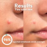 ⁦رقع سبوت باتشز من سكين تشويس - رقع حب الشباب (عبوة من 30 قطعة) رقع غروانية مائية، ملصقات بقعة بثرة، معالجة بقع العيوب، نقاط قوية للبقع، نباتي، لم يتم اختباره على الحيوانات، للعناية بالوجه والبشرة⁩ - الصورة ⁦3⁩